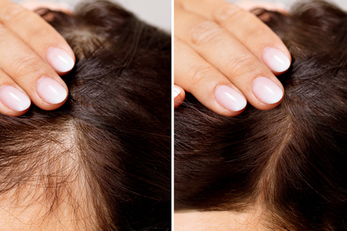 Hair Loss Treatment/ Hair Growth Thearpy